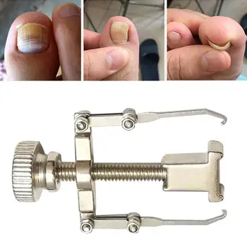 70% Hot Salg Indgroet Toenail Tå Fixer Gendanne Korrektion Enhed Fod Pedicure Nail Care Tool